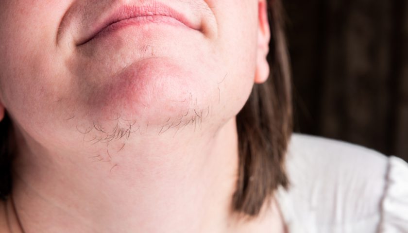 Excessive Hair Growth in Women