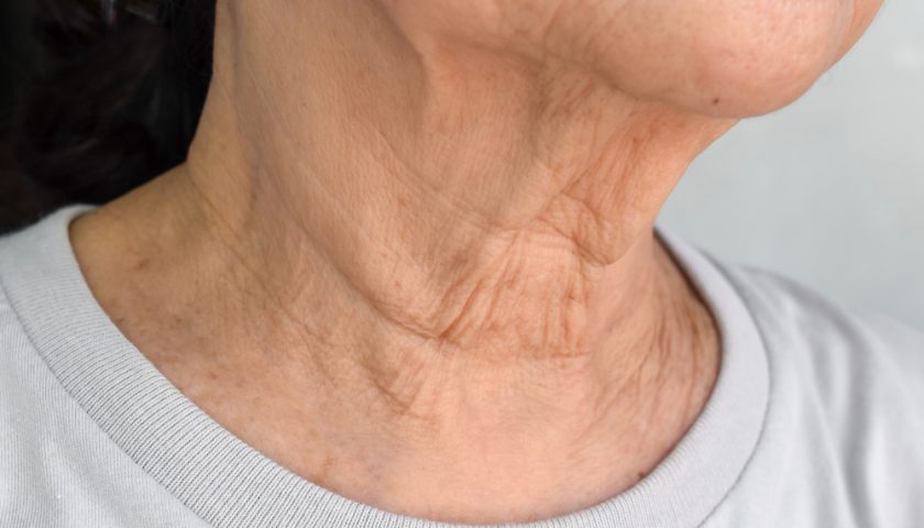 Home Remedies for Neck Wrinkles