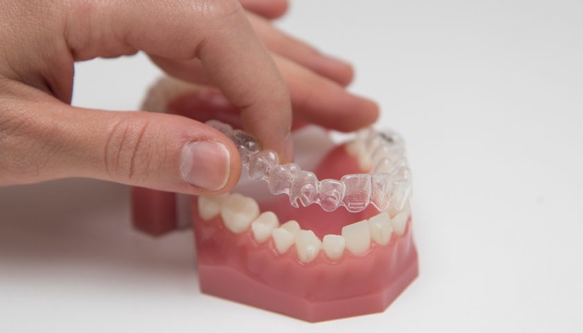 how-does-invisalign-work