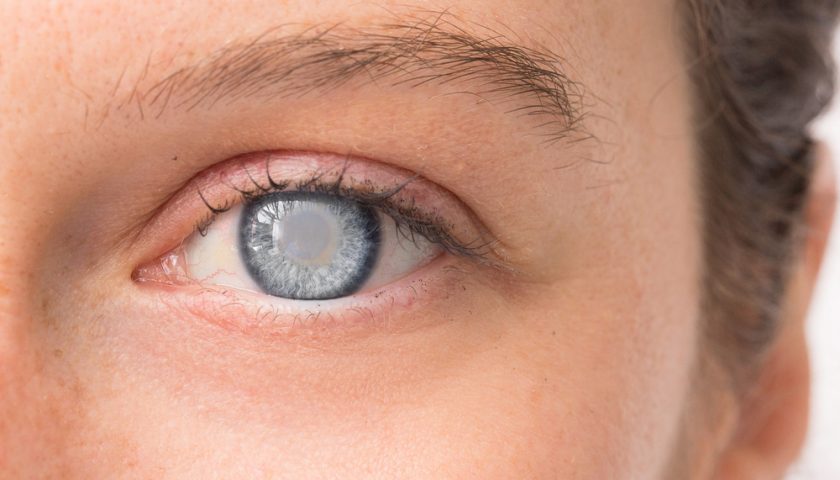 How to Dissolve Cataracts Naturally Without Surgery
