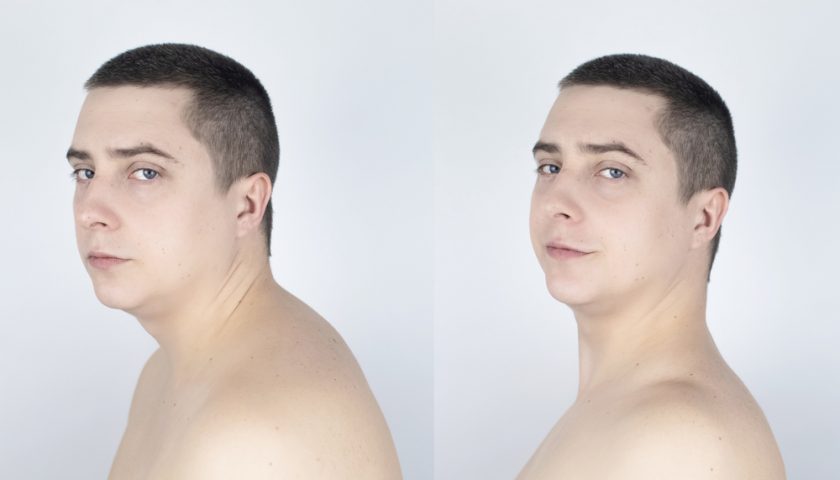How to Fix A Neck Hump