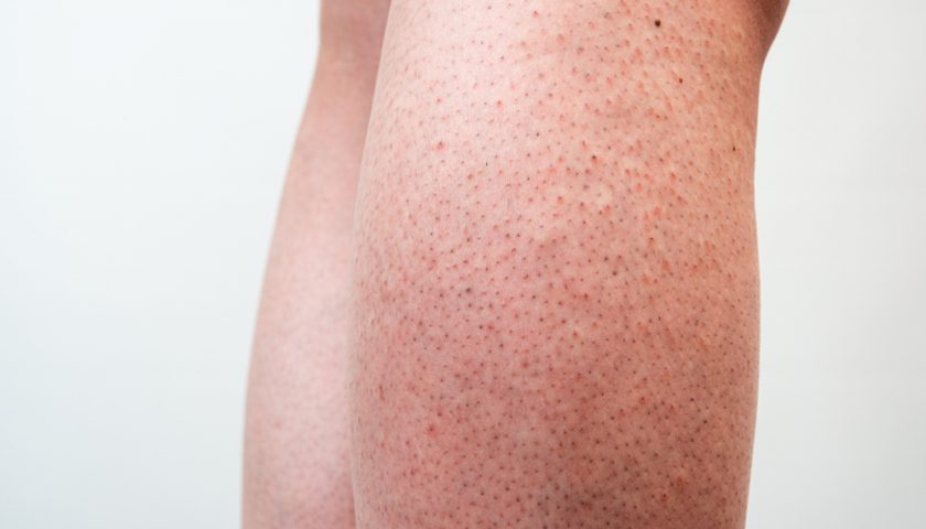 how-to-get-rid-of-strawberry-legs