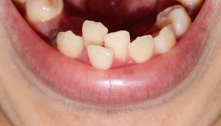 overlapping-teeth-causes-treatment