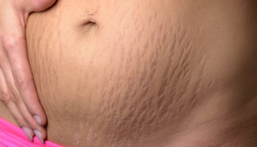 stretch-marks-during-pregnancy