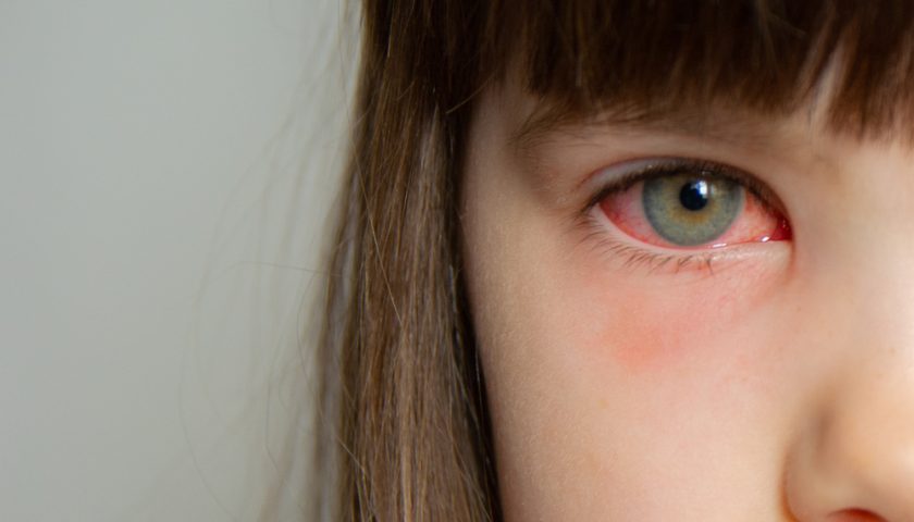 symptoms-treatment-and-prevention-of-pink-eye