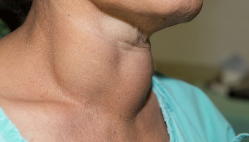 thyroid-cancer