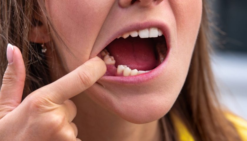 tooth-loss-treatment-options