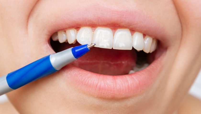 White Spots on Teeth