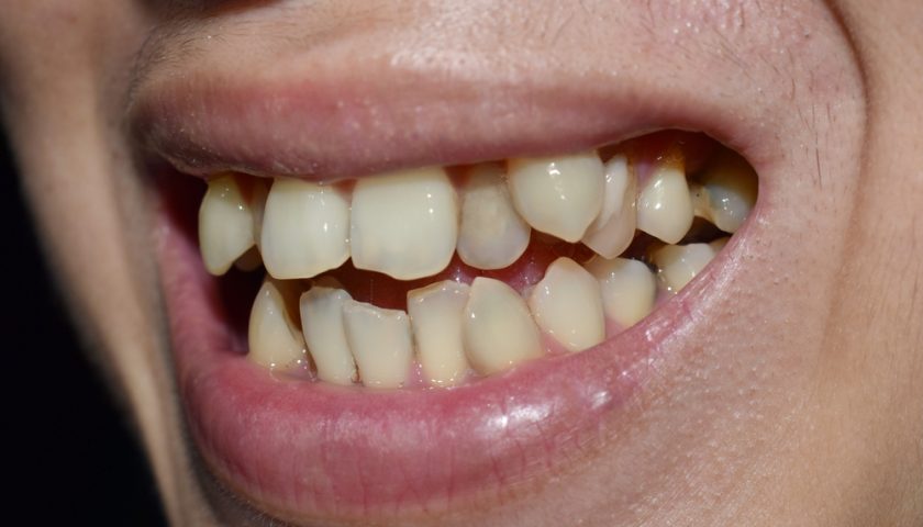 Wisdom Tooth Impaction