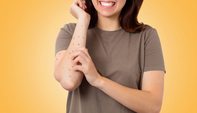 Home Remedies To Get Rid Of Scabies