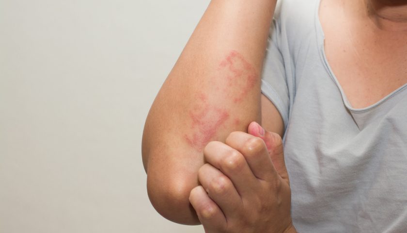 Scabies Treatments