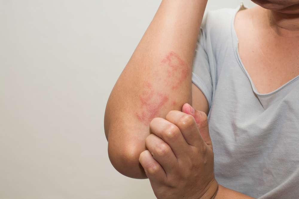 Scabies Treatments – Medications and 7 Natural Home Remedies to