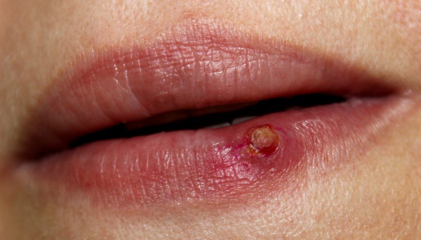 Granuloma