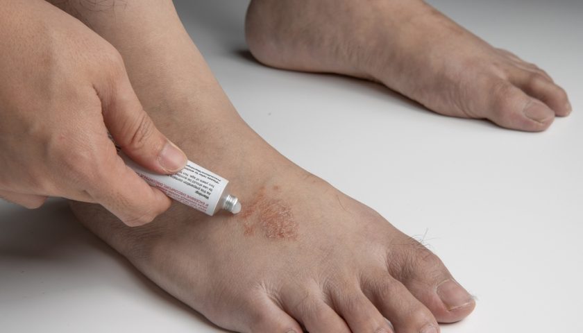 Antifungal Cream in Pakistan