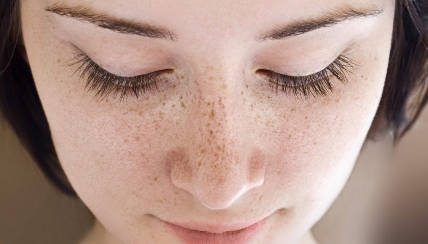 Best Methods for Freckles Treatment