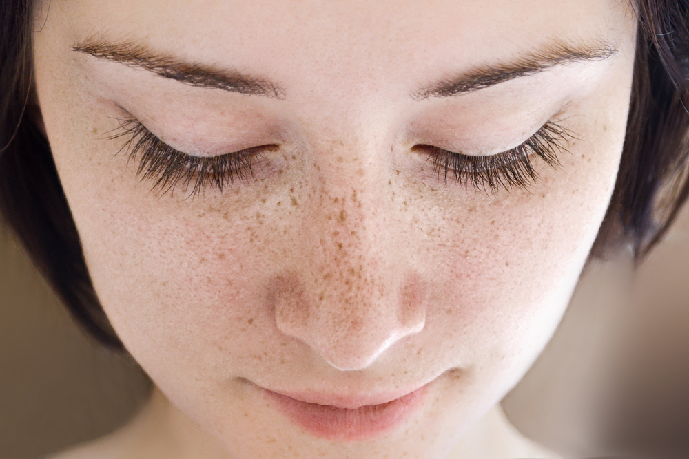 10 of the Best Methods for Freckles Treatment - Healthwire