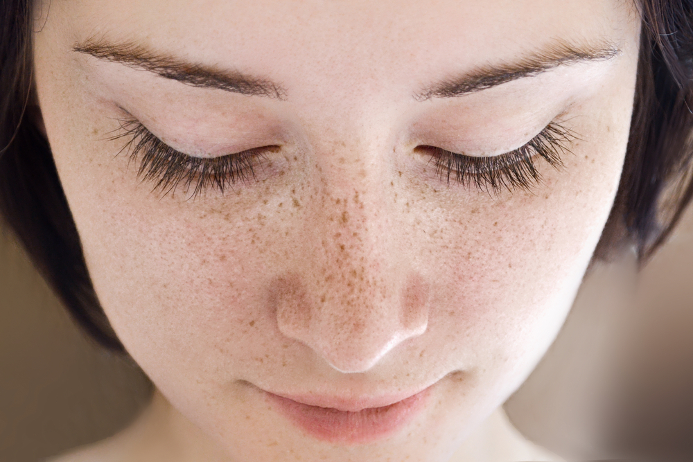 freckles on face