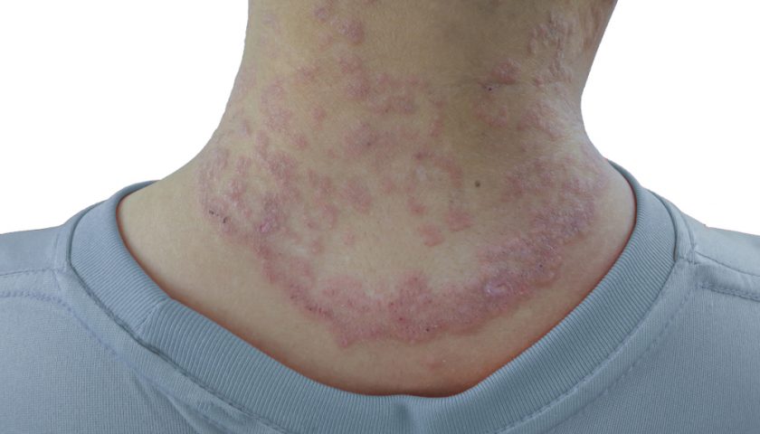 Fungal Infection Ka Ilaj