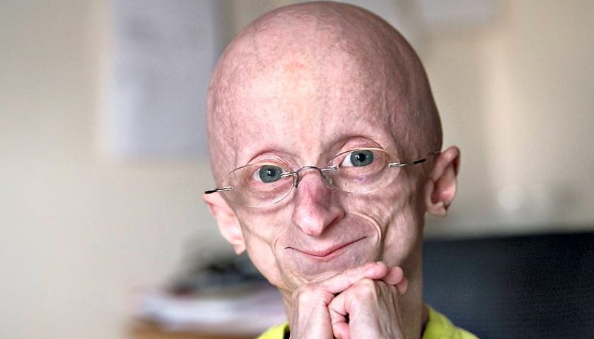Hutchinson-gilford-progeria-syndrome