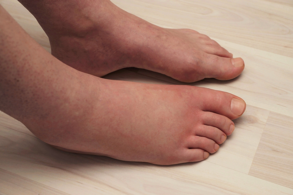 What Causes Your Feet To Swell And Be Red