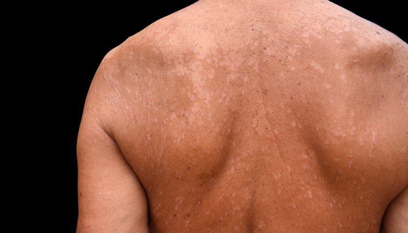 What is Tinea Versicolor