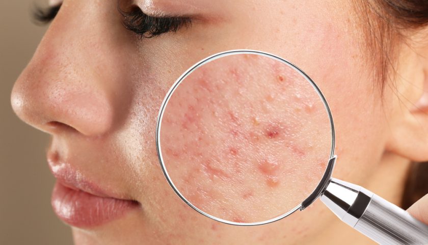 Acne Ka Ilaj
