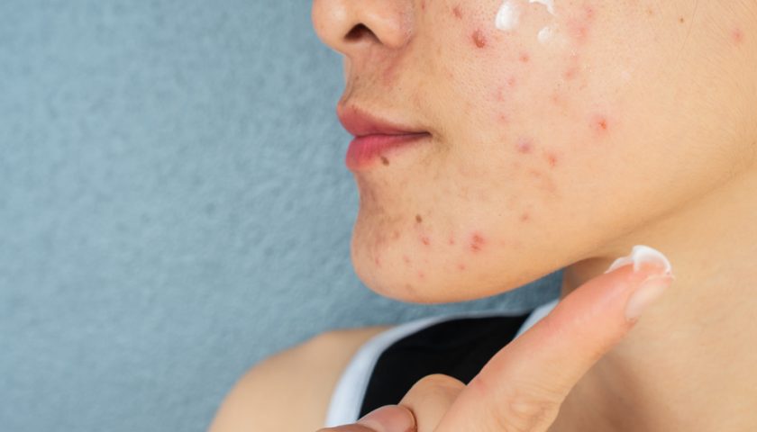 Best Acne Creams in Pakistan