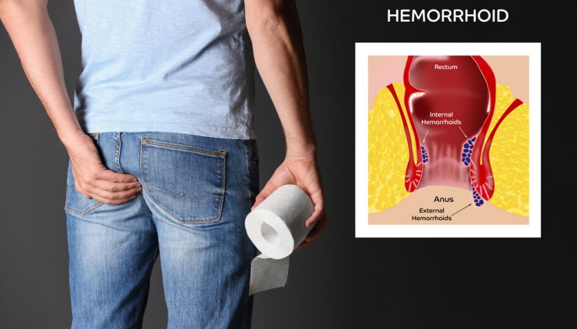 External Hemorrhoids Treatment