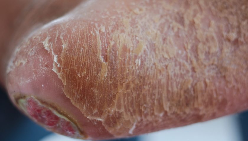 Cellulitis Treatment