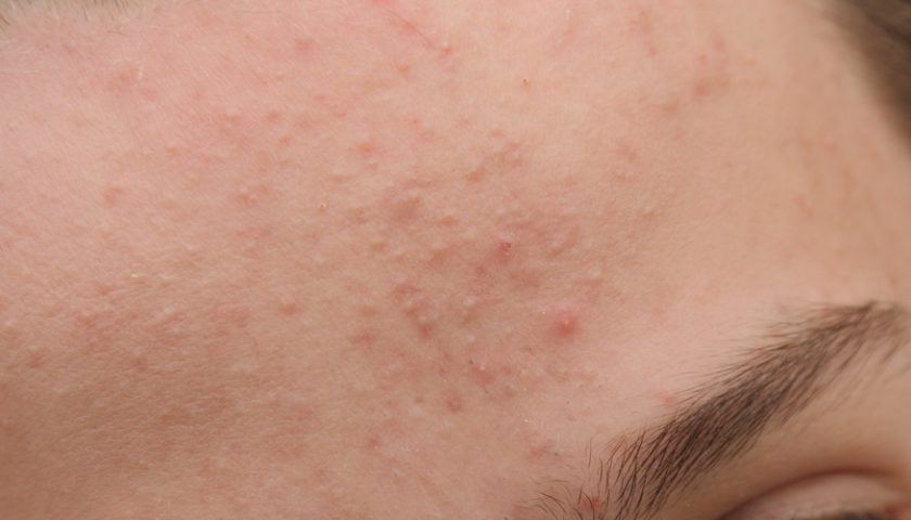 How to Identify and Treat Fungal Acne? - Health & Wellness Blog