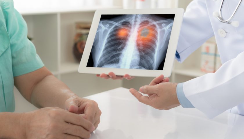 lung cancer