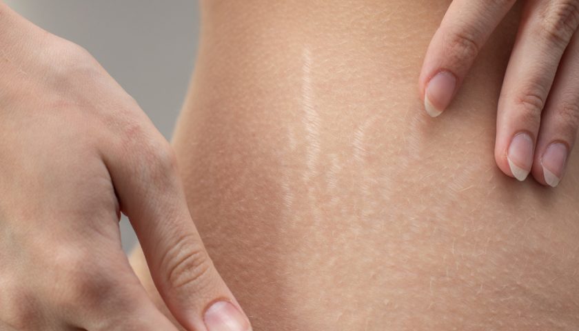 Pregnancy skin tags
