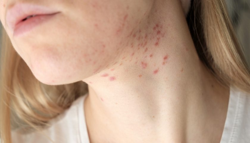 Treat Fungal Acne