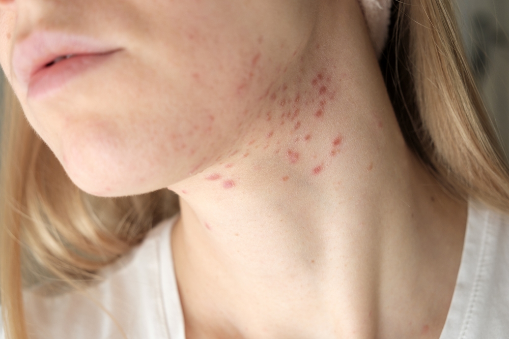 How To Identify And Treat Fungal Acne Health And Wellness Blog