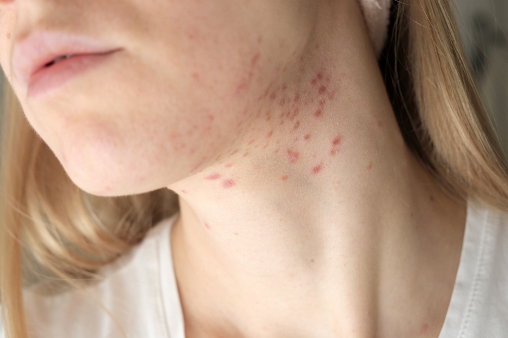 How To Identify And Treat Fungal Acne Health Wellness Blog 