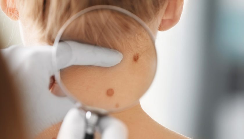 Birthmark Types
