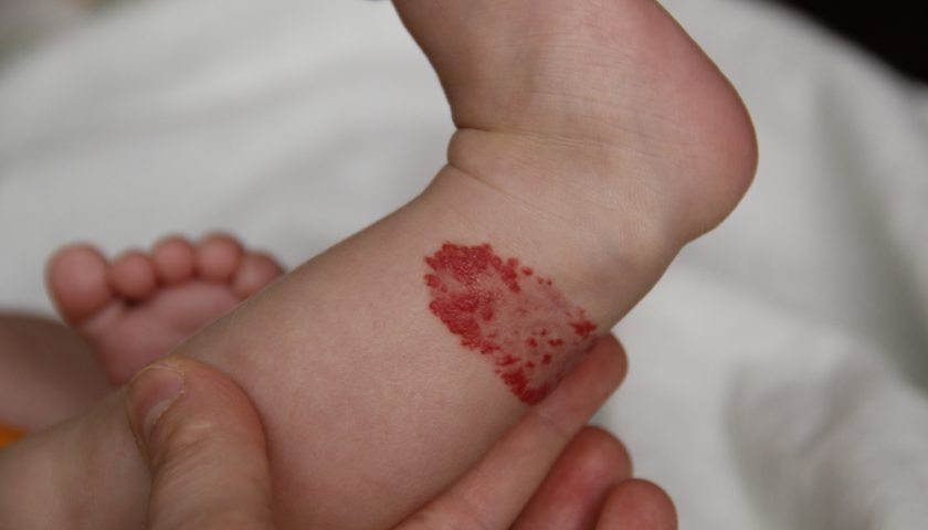 Birthmark Types; Moles, Macular Stains, Port-Wine Stains and More ...