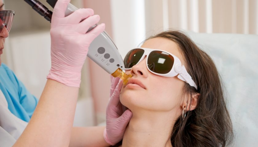 Q Switch Laser procedure