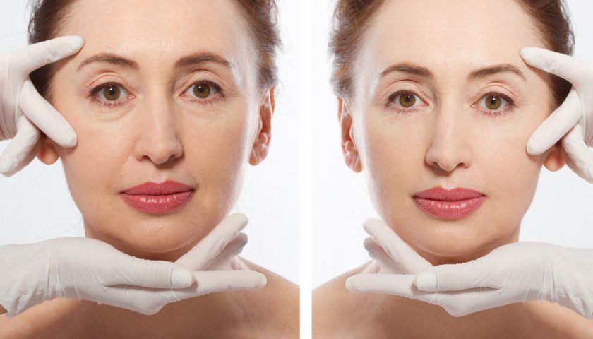 The Vampire Facelift