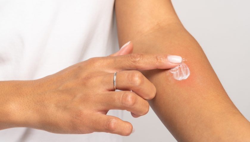 Skin Allergy Creams