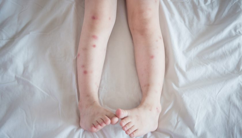 Managing Red Spots on Legs
