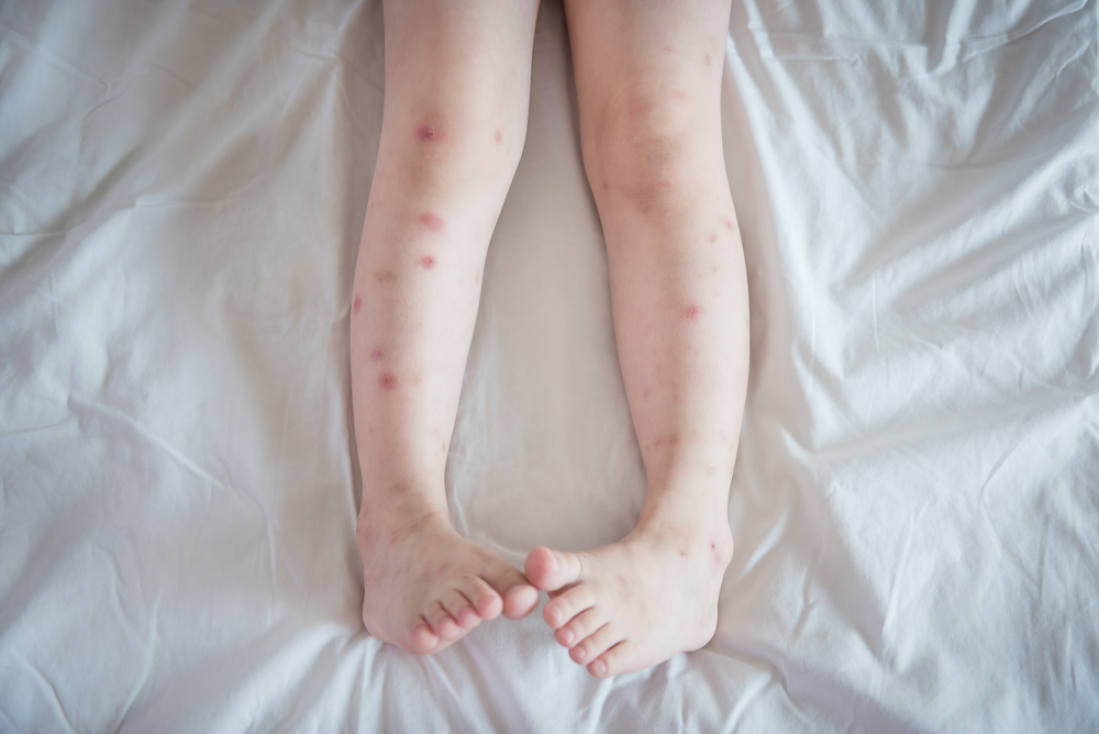 managing-red-spots-on-legs-common-causes-and-treatment-healthwire