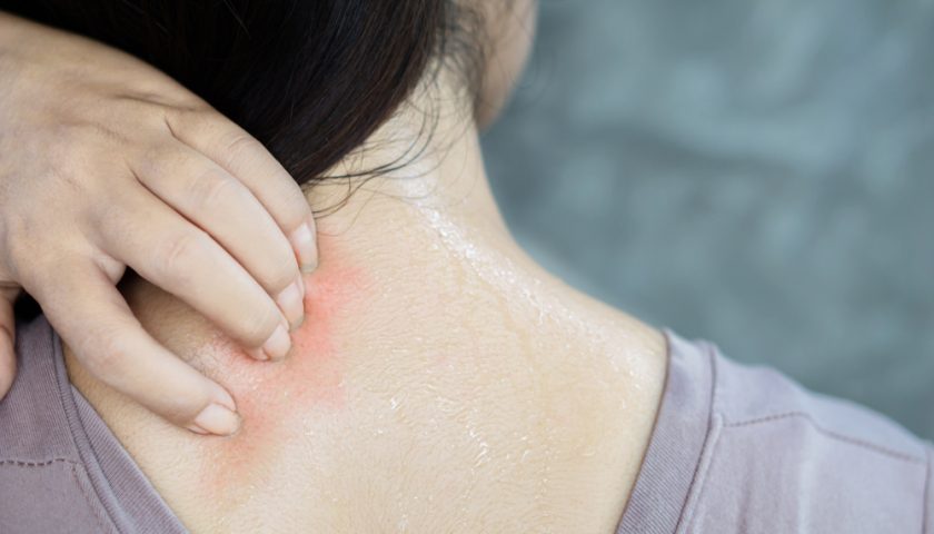 Heat Rashes