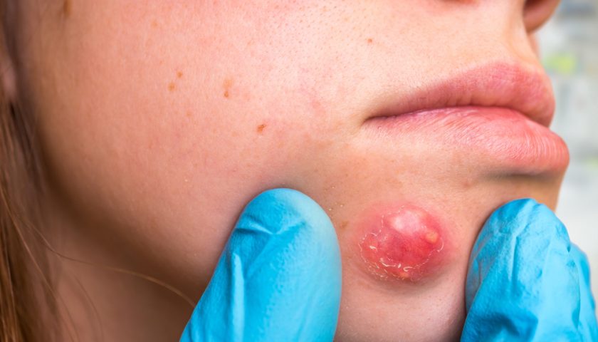 How to Get Rid of a Boil Overnight