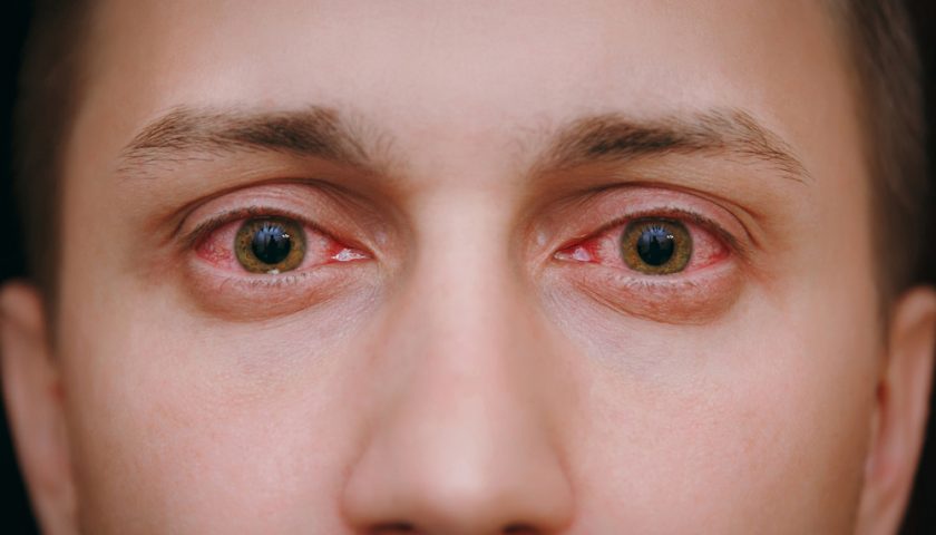 Red Eyes Remedies
