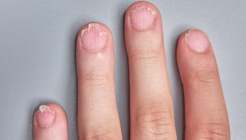 Brittle Nails