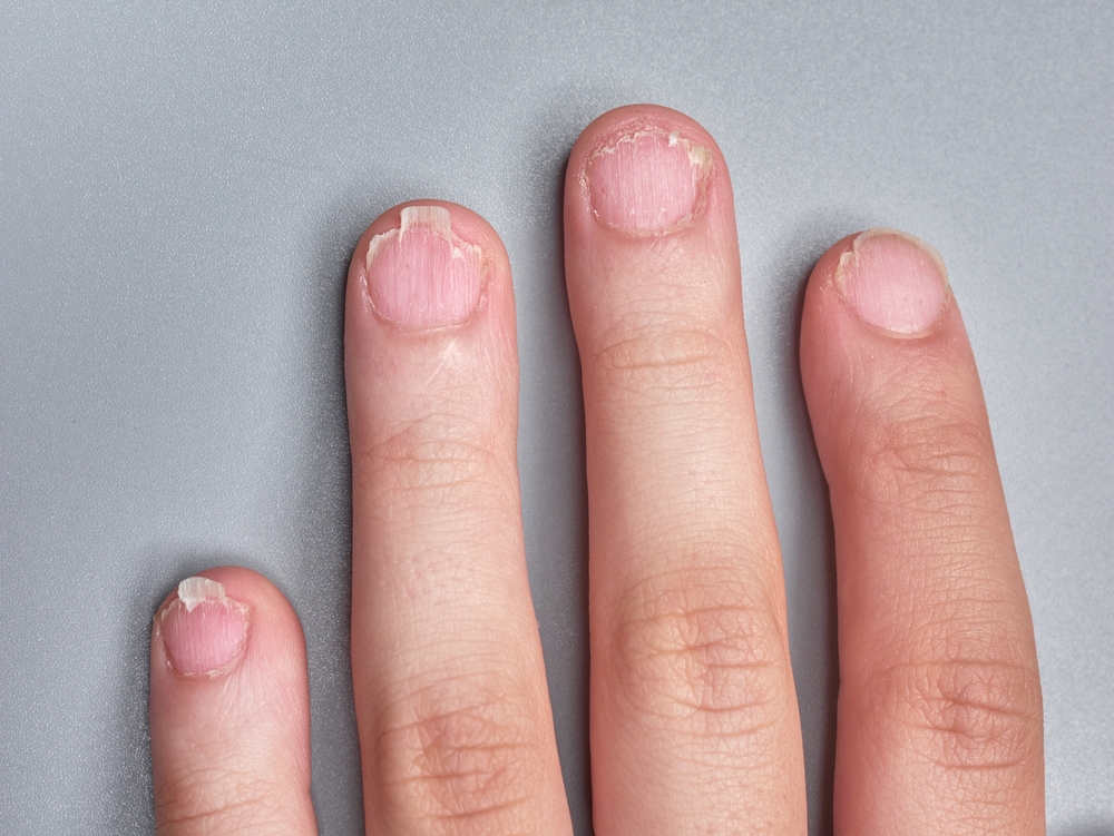Peeling Nails: Causes And Prevention, According To Doctors