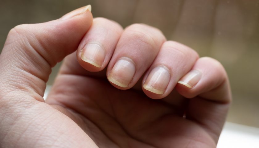 How To Fix Yellow Nail in 2023