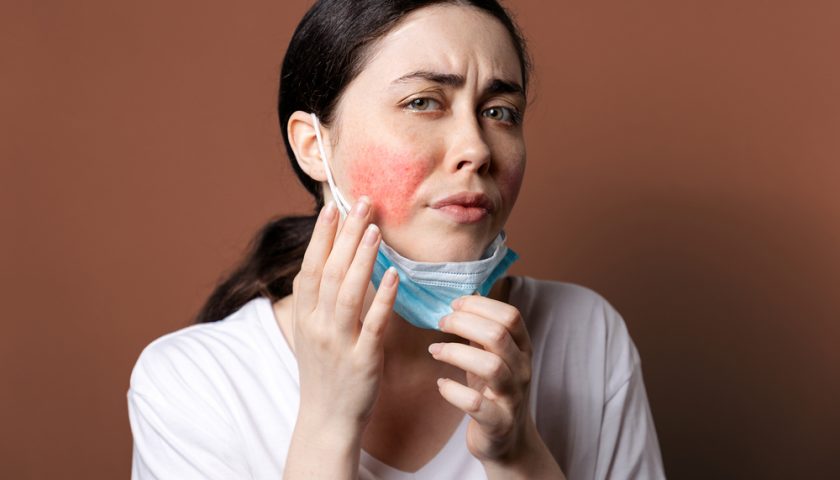 How to Get Rid of Rosacea Permanently