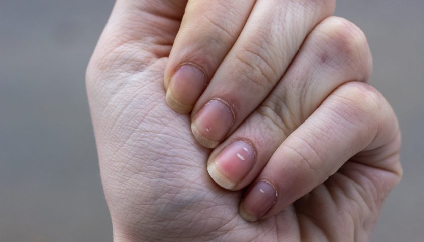 How to Get Rid of White Spots on Nails